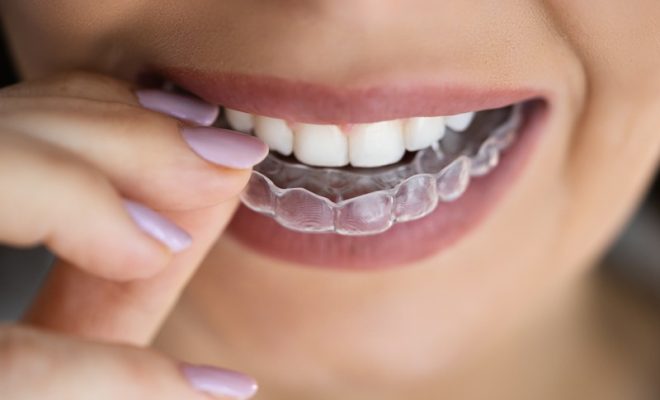 Which Questions Should Your Dentist Ask About Invisalign?