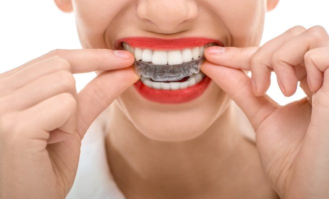 Why Do Some People Prefer Invisalign Over Braces?
