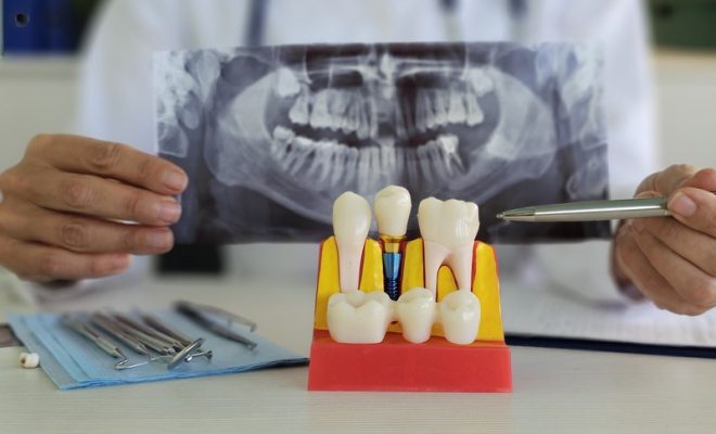What Makes Dental Implants an Affordable Solution for Tooth Replacement?